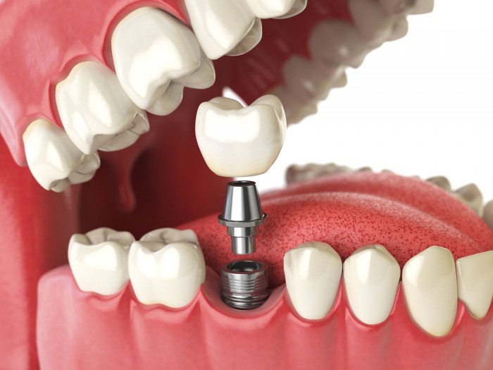 Dental Implants Page 3 Health And Hospitals Philippines Expats Forum 8718